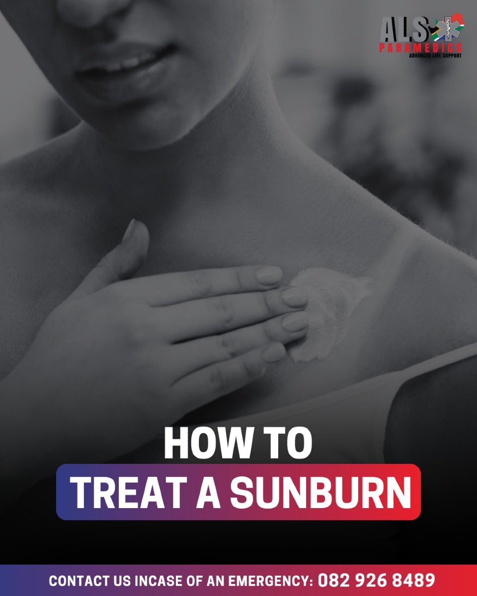 Sunburn Tips for Summer Fun